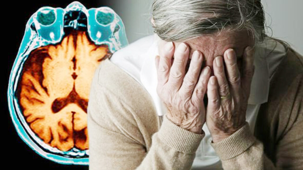 SALUTE |Alzheimer, ricercatori italiani scoprono molecola che blocca la malattia
