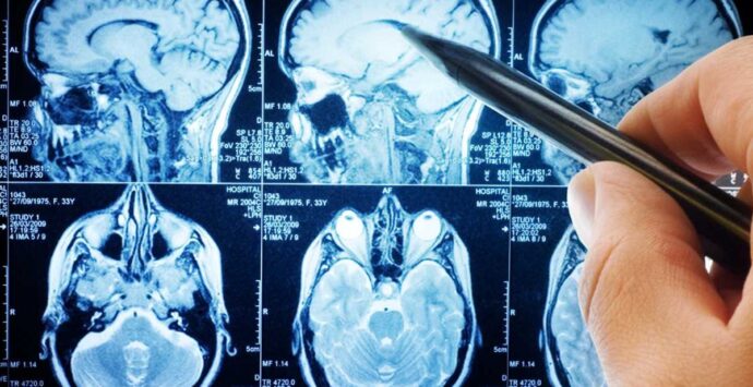 Tumori cerebrali, scoperto un nuovo farmaco: rallenta il peggioramento della malattia