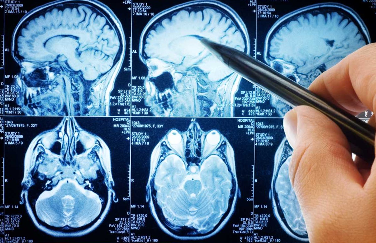 Tumori cerebrali, scoperto un nuovo farmaco: rallenta il peggioramento della malattia